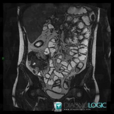 Maladie-Crohn, Intestin grêle, IRM