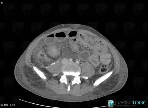 Maladie-Crohn, Intestin grêle, Scanner