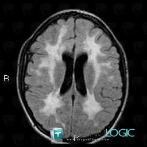Maladie d'Alexander, Hémisphères cérébraux, Ventricules / Région périventriculaire, IRM