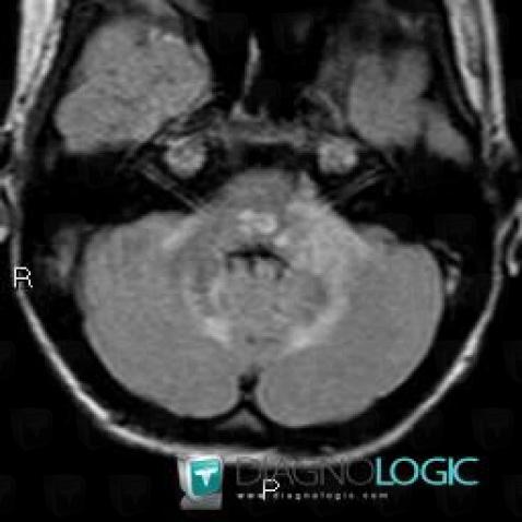 Maladie d'Alexander, Tronc cérébral, Hémisphère cérébelleux, IRM