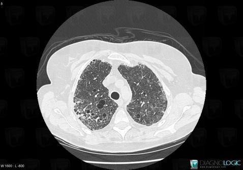 Maladie d'Erdheim-Chester, Parenchyme pulmonaire, Scanner
