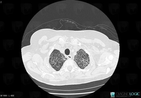 Maladie d'Erdheim-Chester, Parenchyme pulmonaire, Scanner