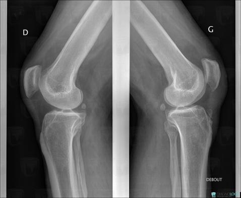 Maladie d'Osgood-Schlatter, Tibia -supérieur, Radio