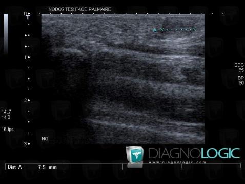 Maladie-dupuytren, Autres parties molles/nerfs - Poignet, Echographie