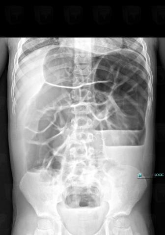 Maladie-Hirschsprung , Rectum, Radio