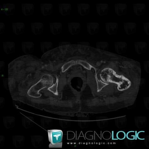 Maladie-Paget, Fémur -supérieur, Scanner