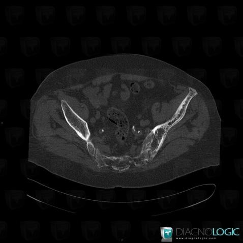 Maladie-Paget, Os iliaque, Scanner