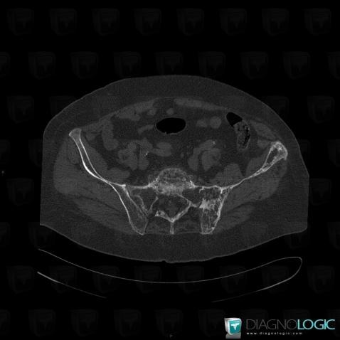 Maladie-Paget, Sacrum / Coccyx, Scanner