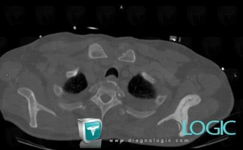 Maladie-Paget, Scapula, Scanner