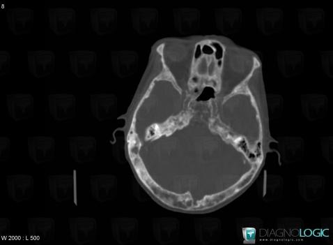 Cas radiologie : Maladie de Paget (Scanner) - Diagnologic
