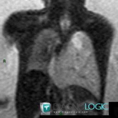 Malformation adénomatoïde kystique pulmonaire, Parenchyme pulmonaire, IRM