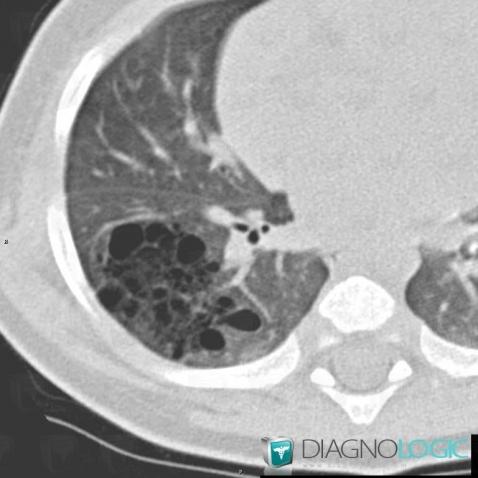 Malformation adénomatoïde kystique pulmonaire, Parenchyme pulmonaire, Scanner