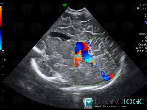 Malformation artério veineuse de-veine-Galien, Veines cérébrales, Echographie