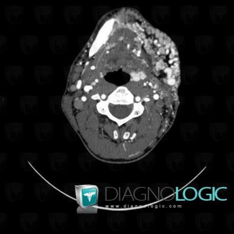 Cas radiologie : Malformation artério-veineuse (Scanner ,IRM) - Diagnologic
