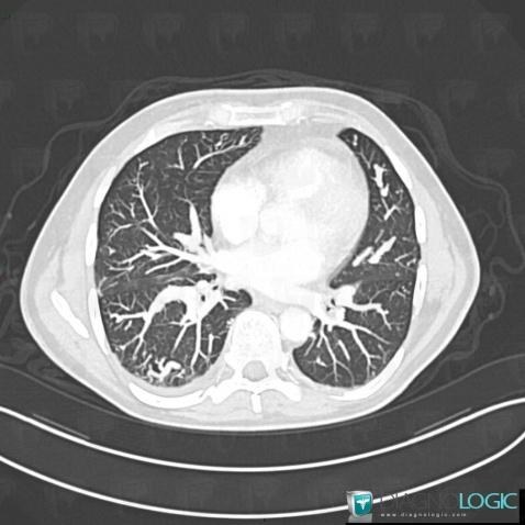 Malformation artério-veineuse, Parenchyme pulmonaire, Scanner