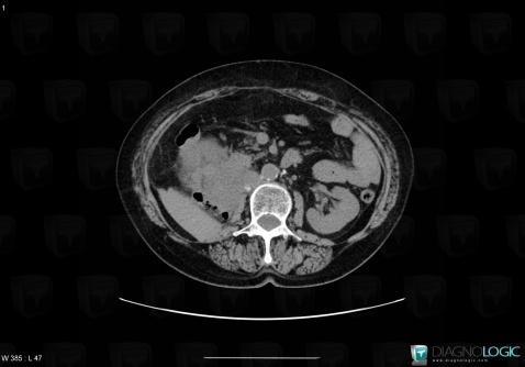 Malignant fibrous histiocytoma, Retroperitoneum, CT