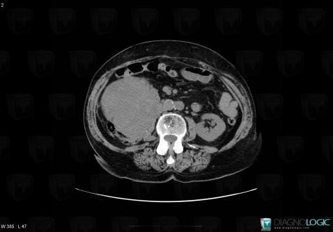 Malignant fibrous histiocytoma, Retroperitoneum, CT