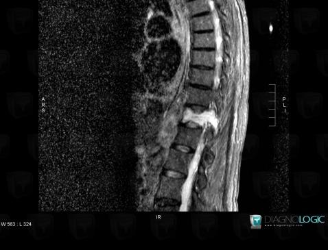 Malignant fibrous histiocytoma, Vertebral body / Disk, MRI