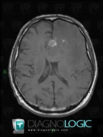 Malignant glioneuronal tumor, Cerebral hemispheres, MRI