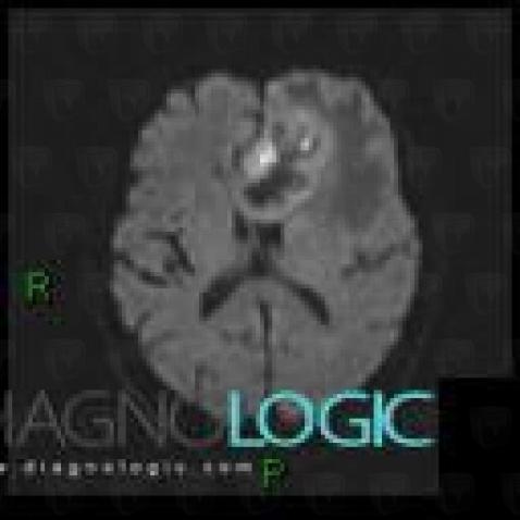 Malignant glioneuronal tumor, Cerebral hemispheres, MRI