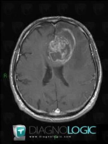 Malignant glioneuronal tumor, Cerebral hemispheres, MRI