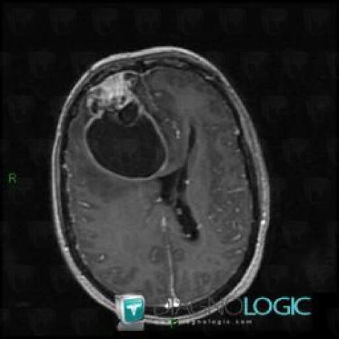 Malignant glioneuronal tumor, Cerebral hemispheres, MRI