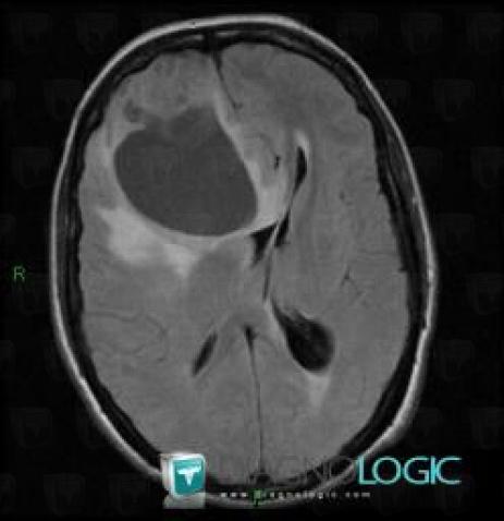 Malignant glioneuronal tumor, Cerebral hemispheres, MRI