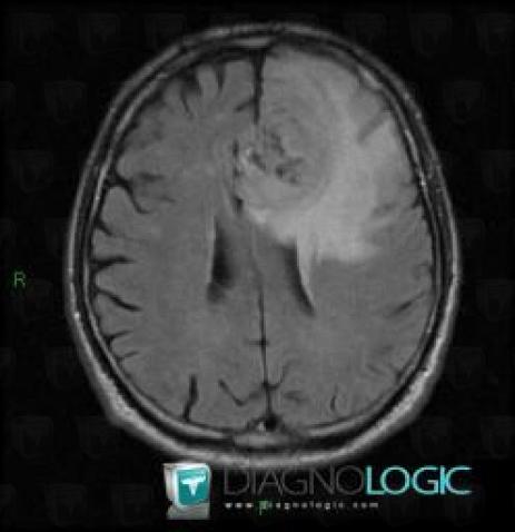 Malignant glioneuronal tumor, Cortico subcortical region, Cerebral hemispheres, MRI