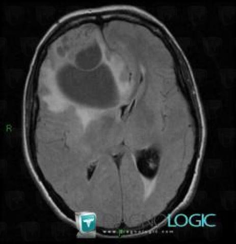 Malignant glioneuronal tumor, Cortico subcortical region, Cerebral hemispheres, MRI