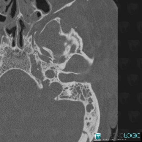 Malignant otitis externa, External ear, CT