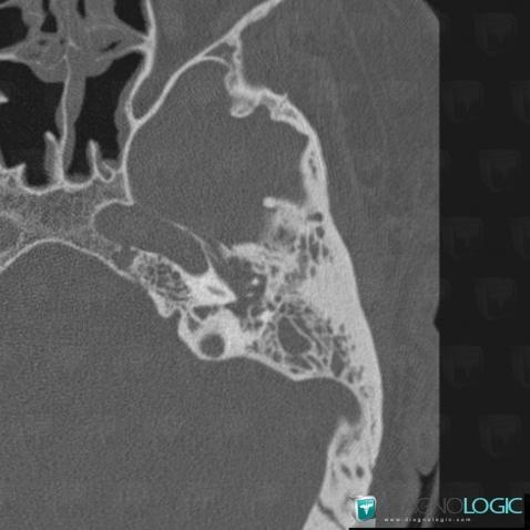 Malignant otitis externa, Middle ear, CT