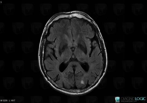 Manganese poisoning , Basal ganglia and capsule, MRI