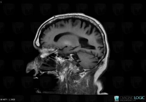 Manganese poisoning , Basal ganglia and capsule, MRI