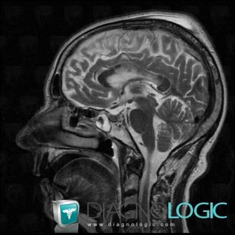 Marchiafava-Bignami disease, Corpus callosum, MRI