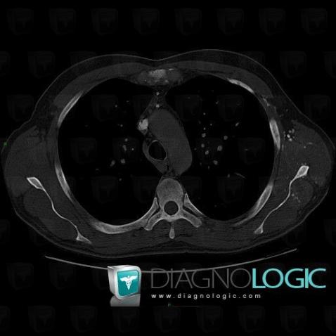 Mastocytosis, CT