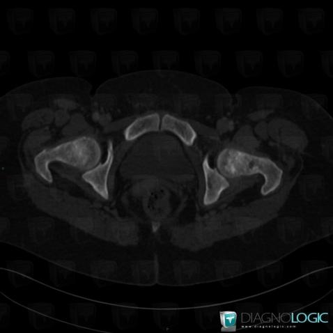 Mastocytosis, Femur - Proximal part, CT