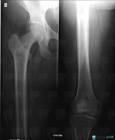 Mastocytosis, Femur - Proximal part, X rays