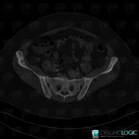 Mastocytosis, Ilium, CT