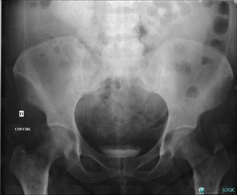 Mastocytosis, Ilium, X rays