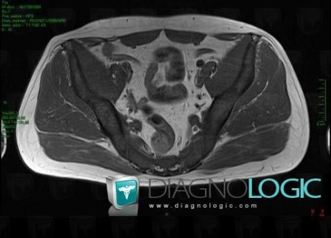 Mastocytosis, MRI