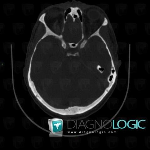 Mastocytosis, Orbital bones, CT