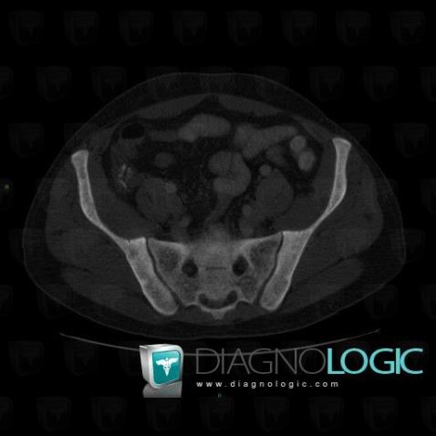 Mastocytosis, Sacrum / Coccyx, CT