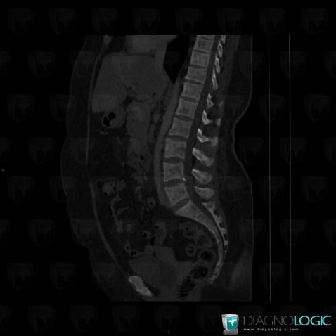 Mastocytosis, Vertebral body / Disk, CT