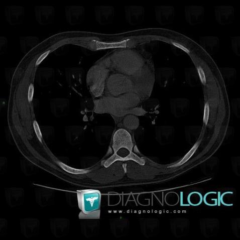 Mastocytosis, Vertebral body / Disk, CT