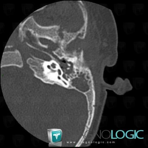 Mastoiditis, Middle ear, CT