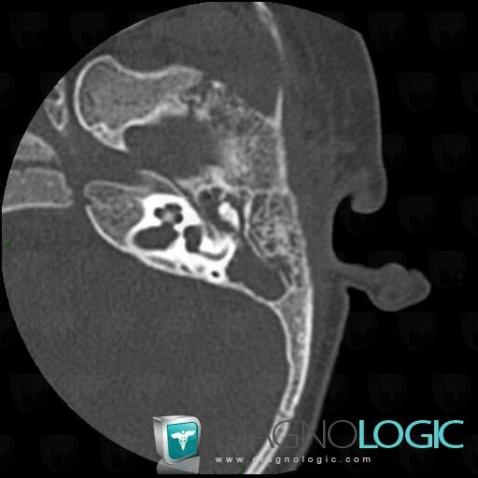 Mastoiditis, Temporal bone, CT