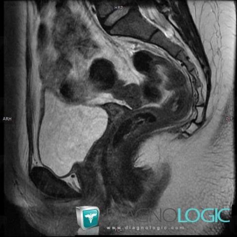 Mayer-Rokitansky-Kuster syndrome, Uterus, MRI