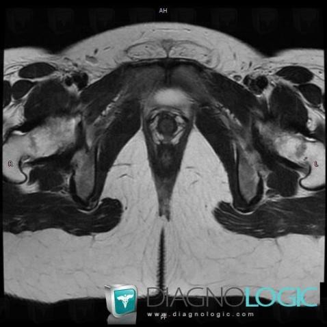 Mayer-Rokitansky-Kuster syndrome, Vagina, MRI