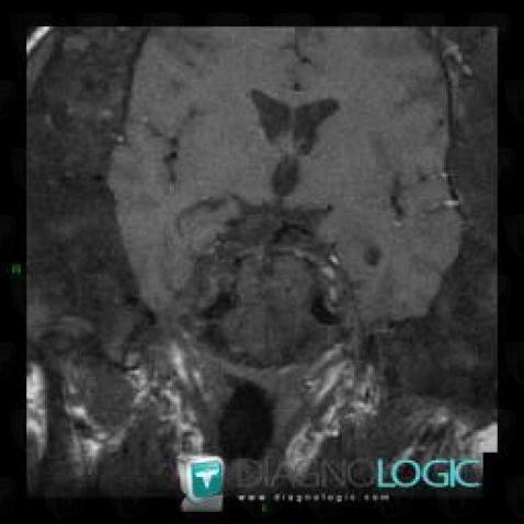 McCune-Albright syndrome, Skull vault, MRI