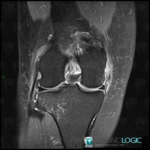 Radiology Case : Medial Collateral Ligament Rupture (MRI) - Diagnologic